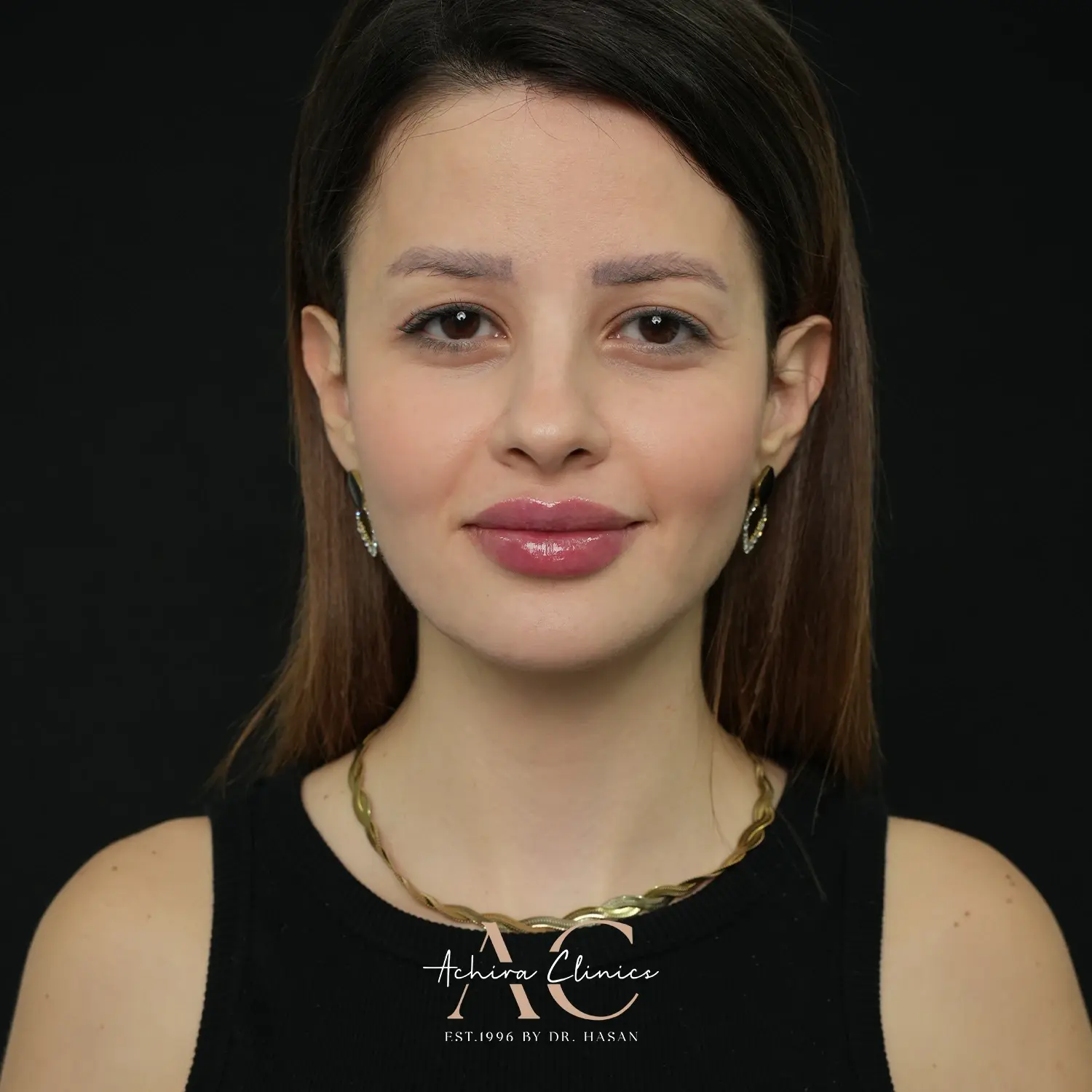 Full face transformation - Achira clinics