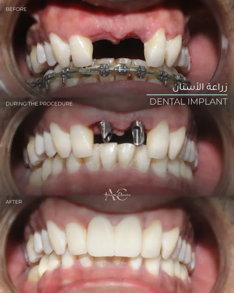 implant-1
