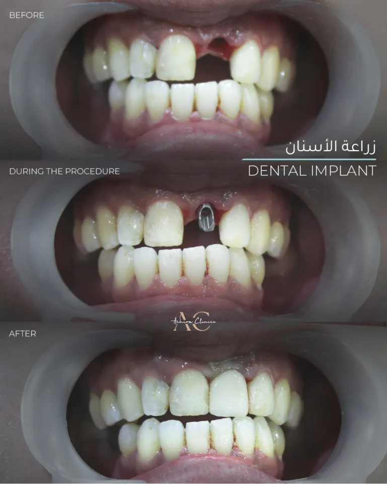 implant-2