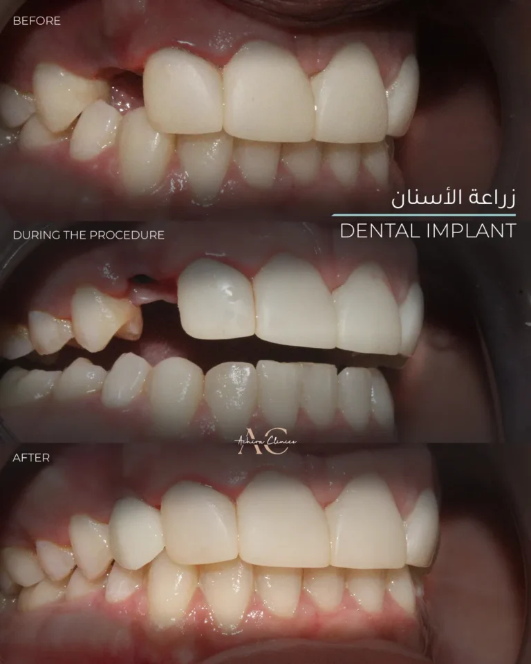 implant-3